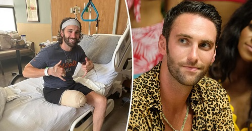 Bachelorette star Cam Ayala reveals leg amputation amid chronic lymphedema